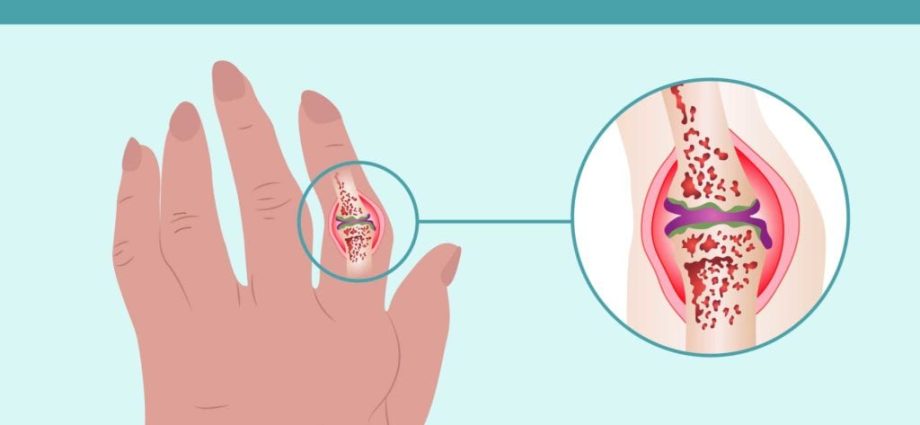 Are your hands cold? It could be rheumatism