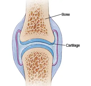 Arthralgia