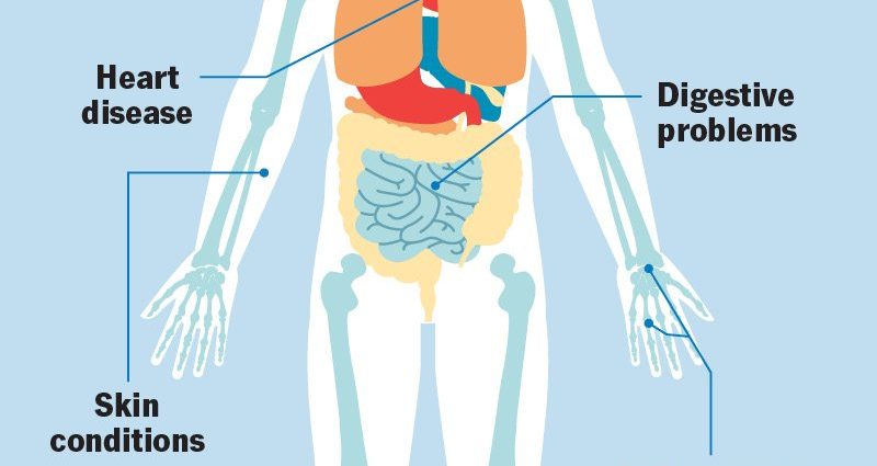 Arthritis &#8211; causes, symptoms, treatment