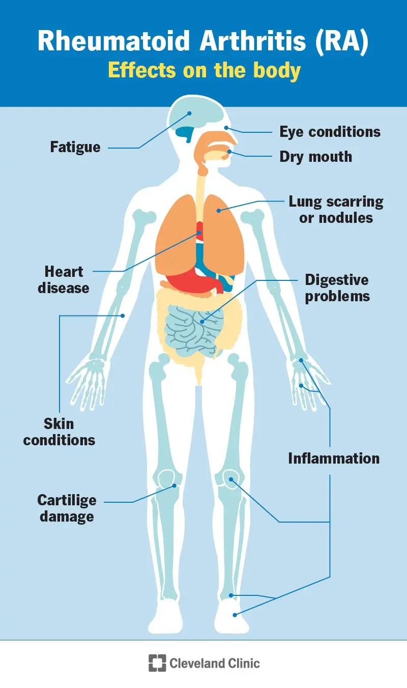 Arthritis &#8211; causes, symptoms, treatment