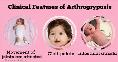 Arthrogryposis &#8211; symptoms, causes, diagnosis, treatment