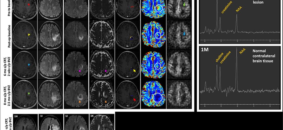 «As if half my brain has been cut off». NOPs after the third dose