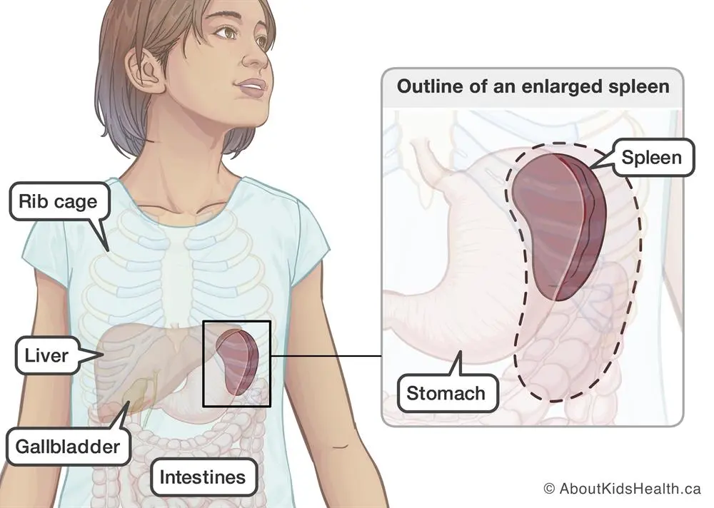 As the spleen grows, test the blood! It could be a genetic disease