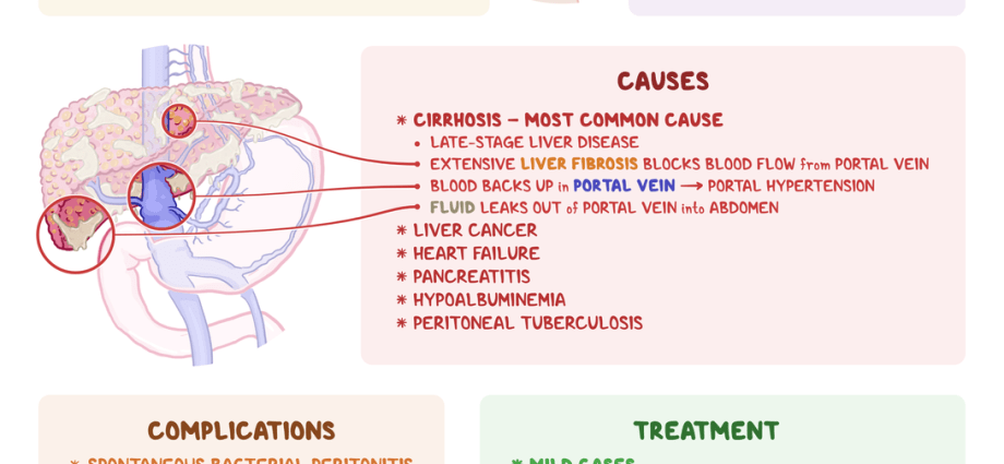 Ascites &#8211; causes, symptoms, treatment