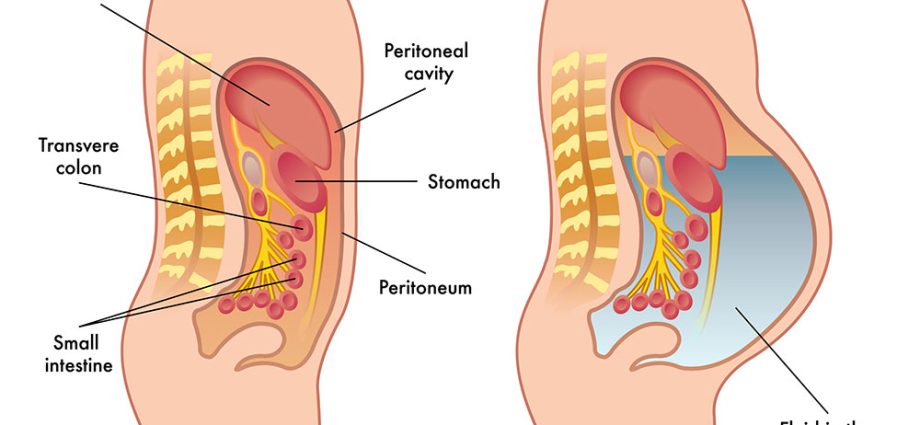 Ascites or fluid in the peritoneal cavity