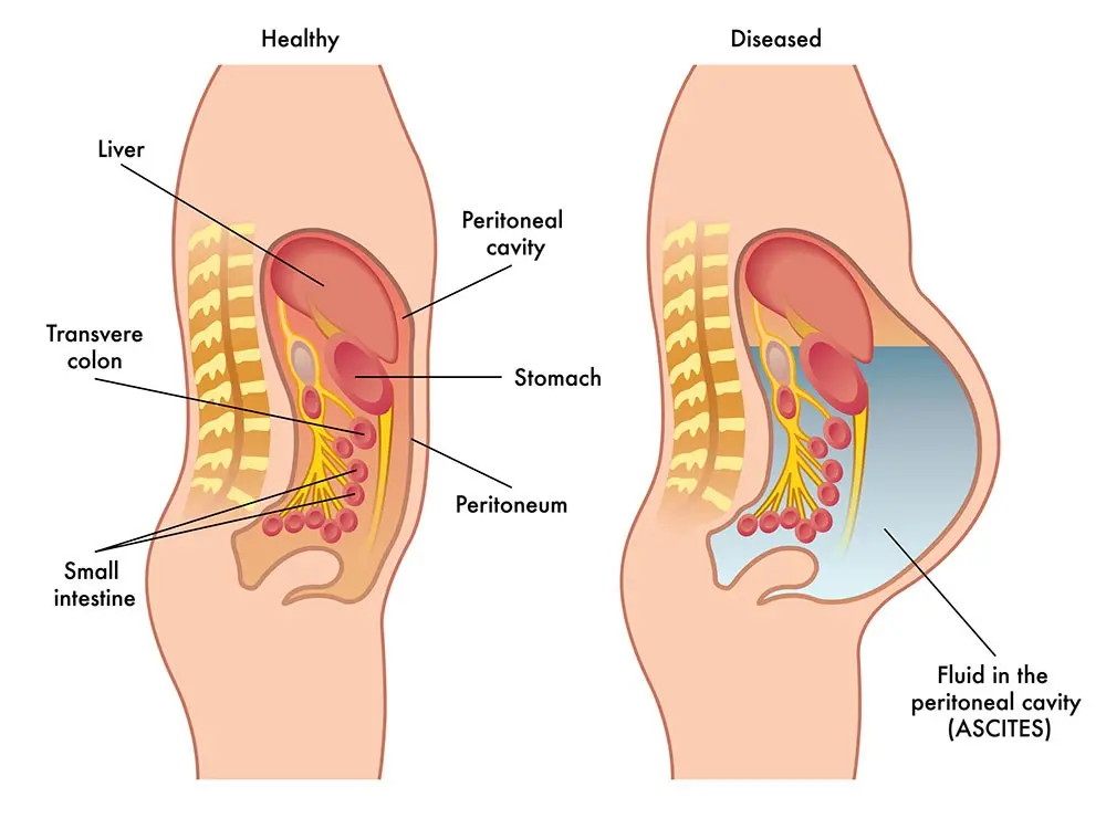 Ascites or fluid in the peritoneal cavity