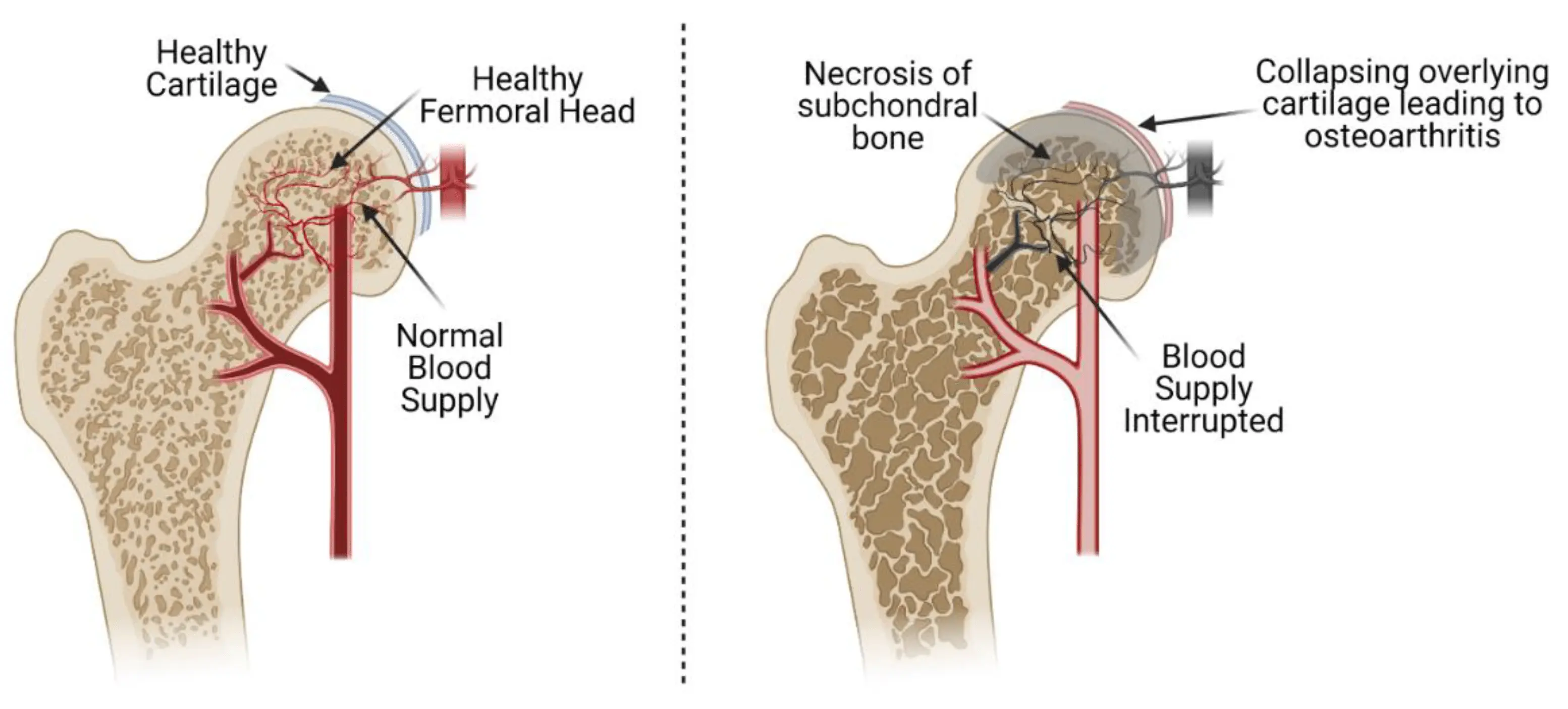 Aseptic bone necrosis &#8211; causes, symptoms, treatment