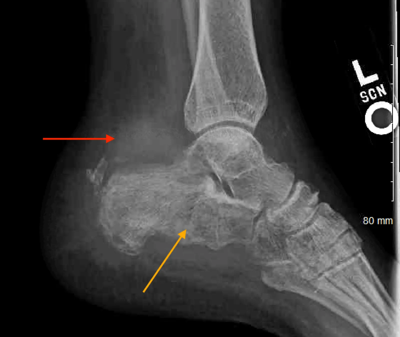 Aseptic necrosis of the calcaneus tumor &#8211; causes, symptoms, diagnosis and treatment