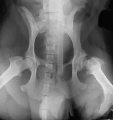 Aseptic necrosis of the femoral head (Calvé-Legg-Perthes disease)