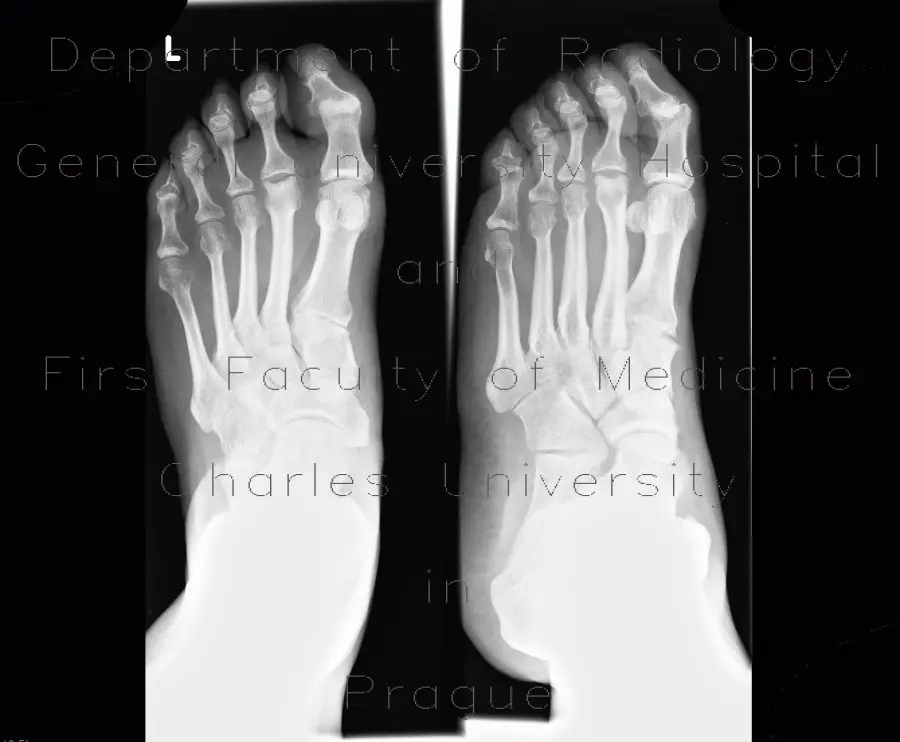 Aseptic necrosis of the head of the XNUMXnd metatarsal (Köhler II disease)