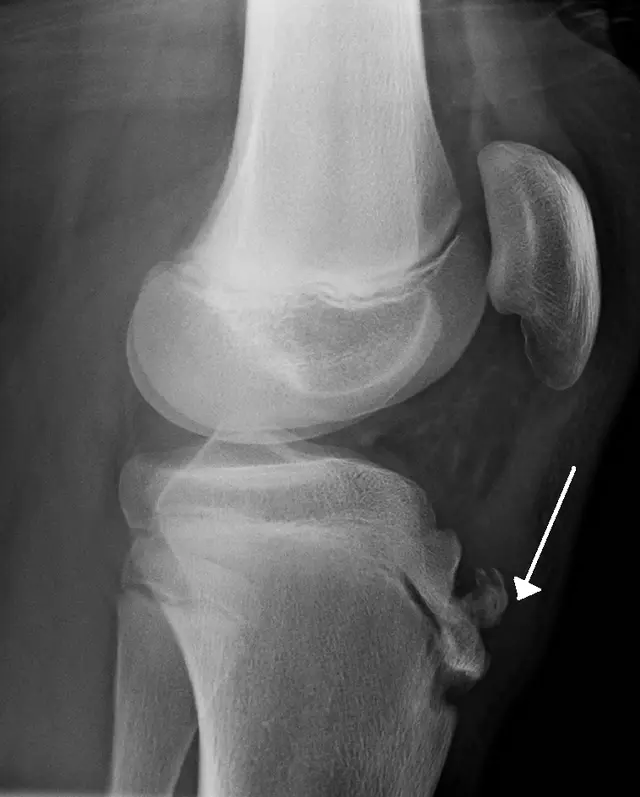 Aseptic necrosis of tuberosity of the tibia (Osgood-Schlatter disease)