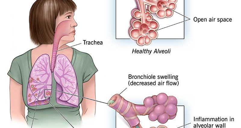 Aspiration pneumonia in children &#8211; causes, symptoms, treatment