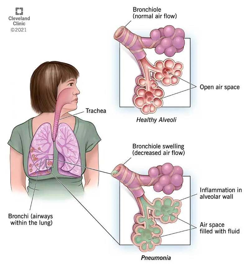 Aspiration pneumonia in children &#8211; causes, symptoms, treatment