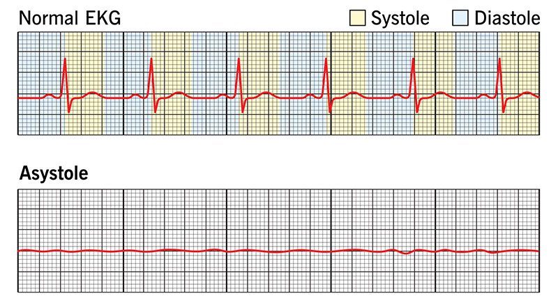 Asystole &#8211; definition, symptoms, causes, management