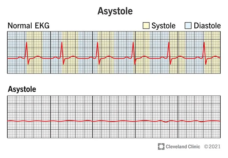 Asystole &#8211; definition, symptoms, causes, management