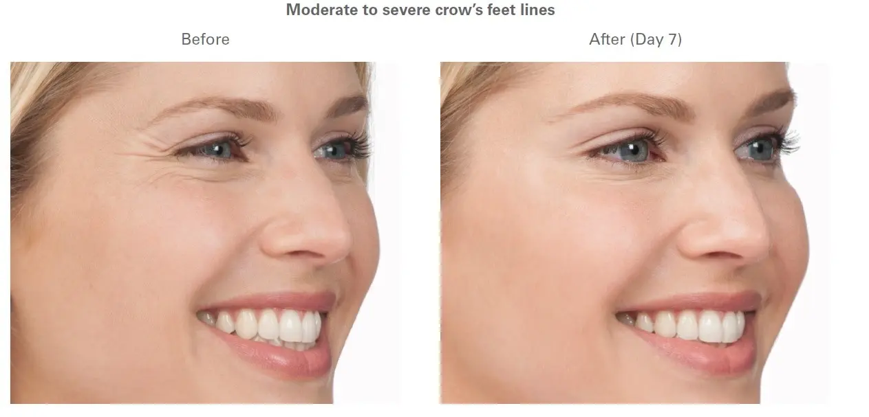 At what age to start doing botox?