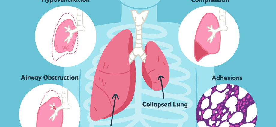 Atelectasis &#8211; causes and symptoms. What is the treatment of atelectasis?