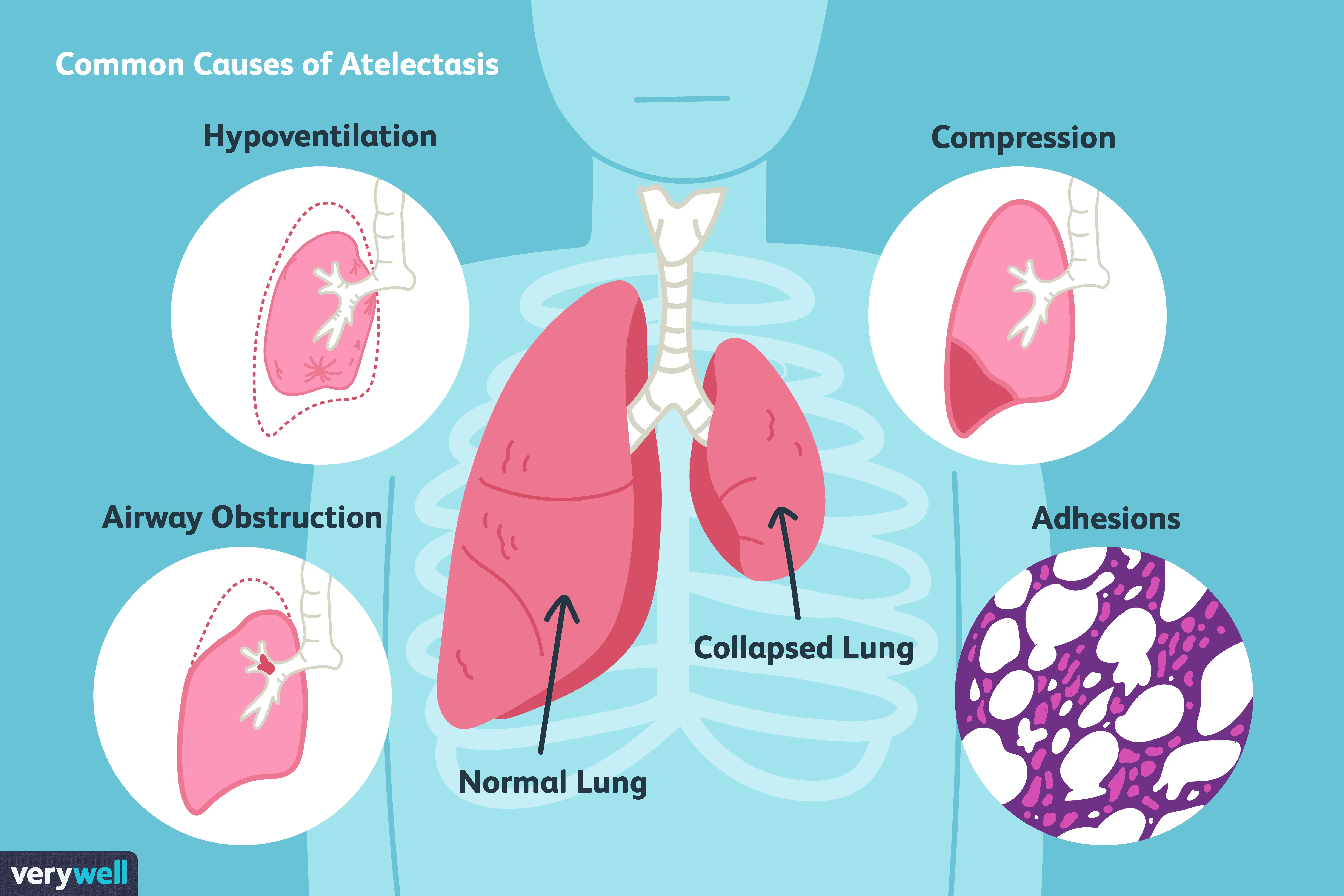 Atelectasis &#8211; causes and symptoms. What is the treatment of atelectasis?