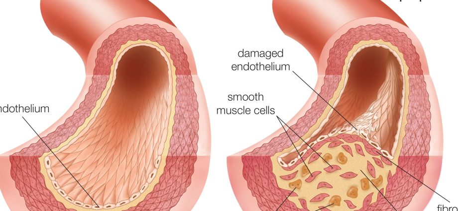 Atherosclerosis of the arteries of the lower extremities &#8211; causes, symptoms, treatment [EXPLAINED]