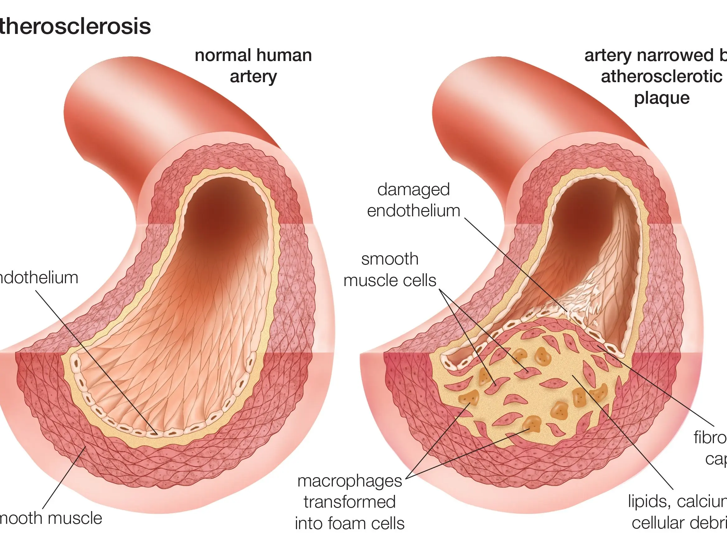 Atherosclerosis of the arteries of the lower extremities &#8211; causes, symptoms, treatment [EXPLAINED]