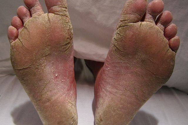Atletsko stopalo – simptomi. Koliko časa traja zdravljenje atletskega stopala?