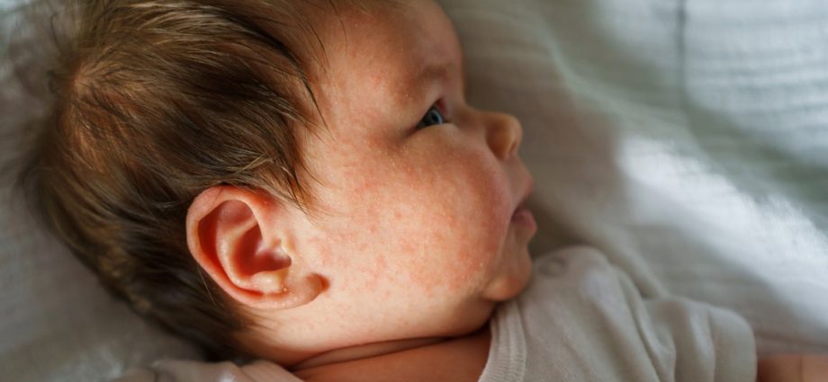 Atopic dermatitis in infants (AD) &#8211; causes, symptoms, treatment