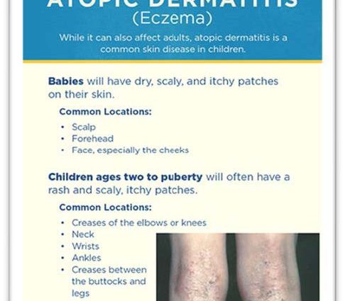 Atopic Dermatitis &#8211; Symptoms and Treatment. What&#8217;s the prognosis?