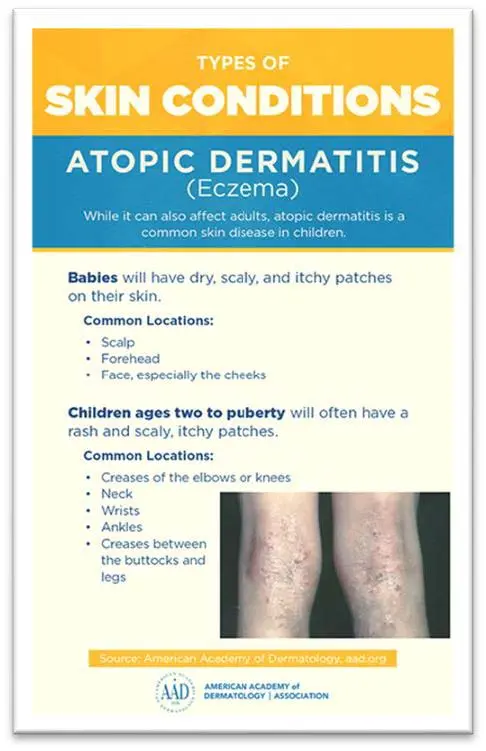 Atopic Dermatitis &#8211; Symptoms and Treatment. What&#8217;s the prognosis?