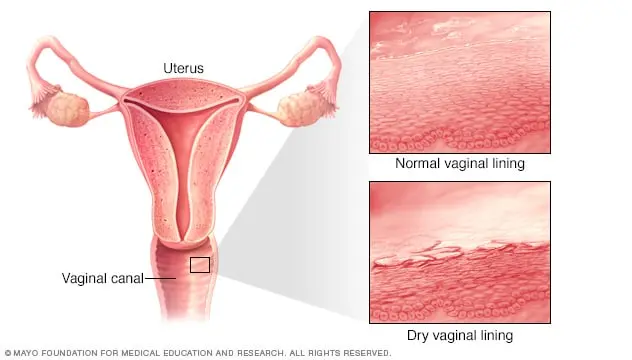 Atrophic vaginitis &#8211; when and why does it occur?