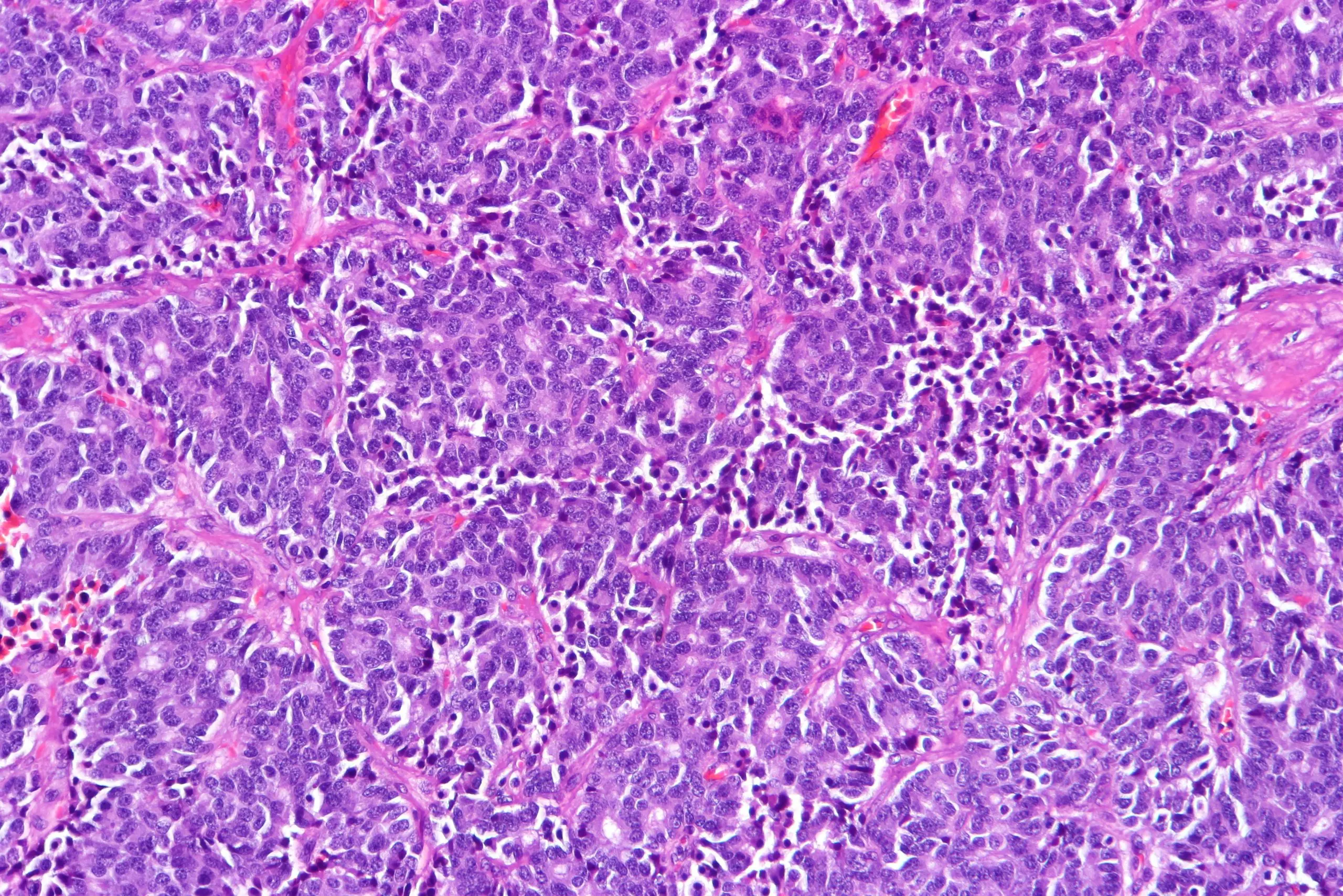 Atypical neoplasms