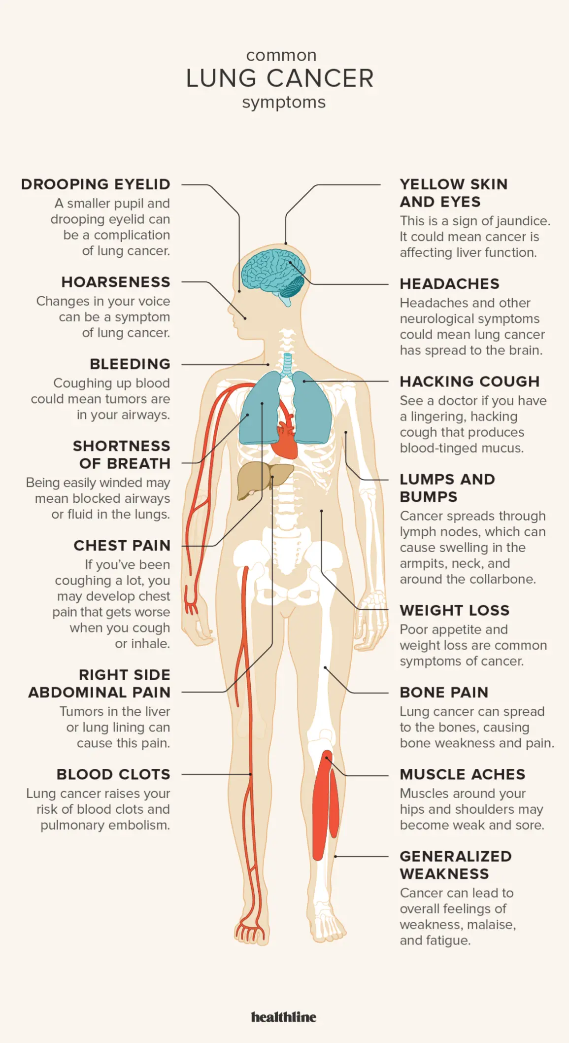 Atypical symptom of lung cancer. Just look at your hands