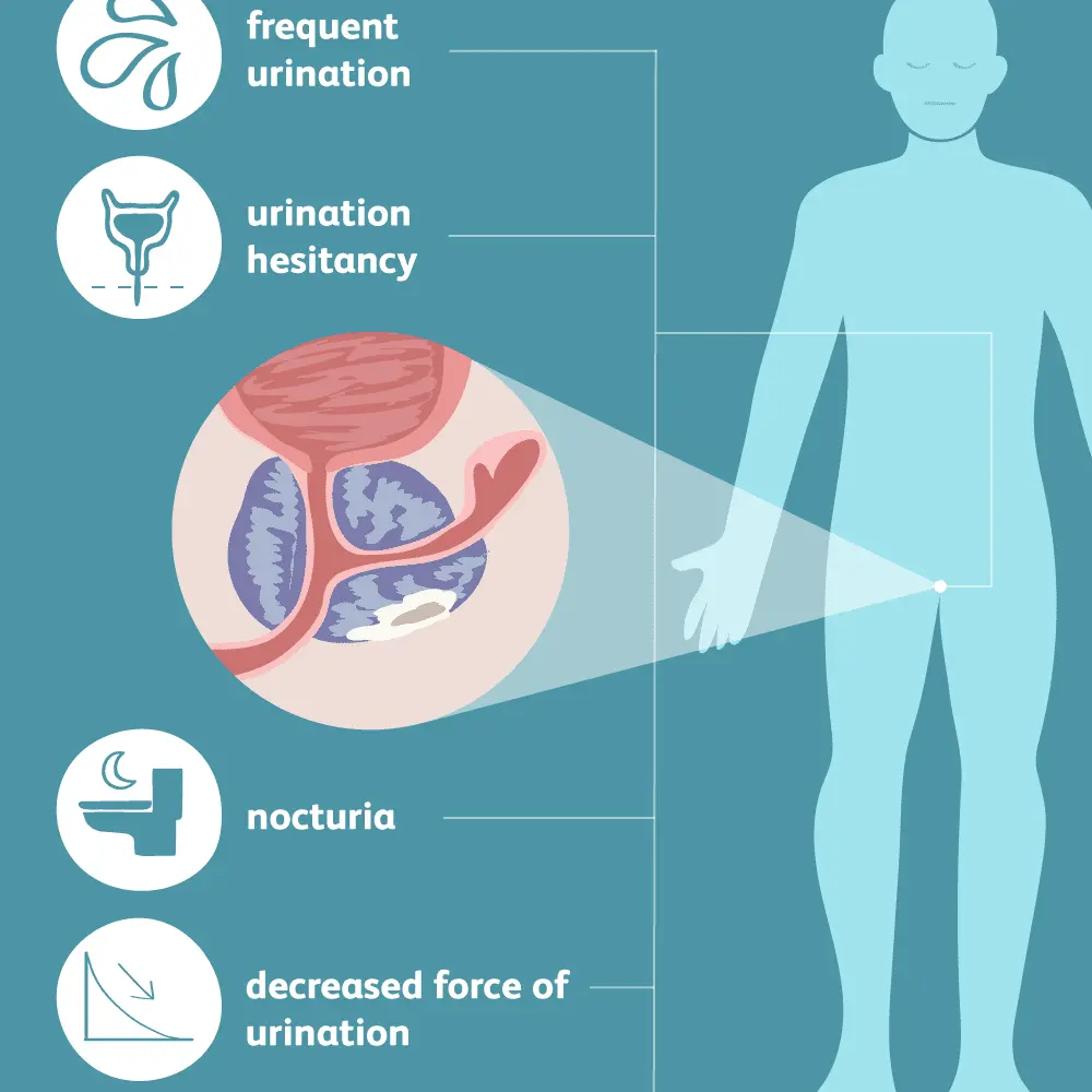 Atypical symptoms of prostate cancer that must not be ignored