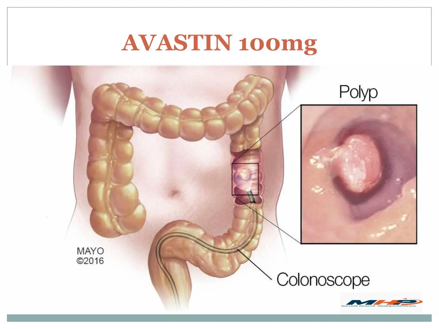 Avastin &#8211; composition, dosage, side effects, price. How does this anti-cancer drug work?