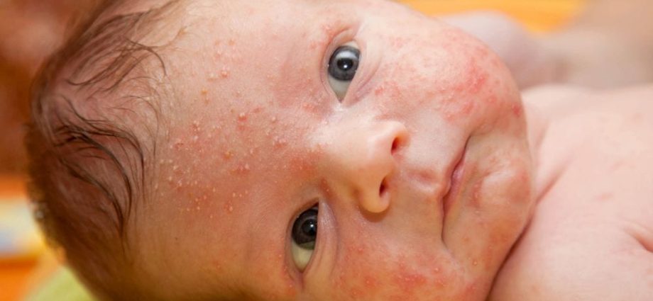 Baby acne &#8211; causes, symptoms, treatment and prevention. Skin care for baby acne