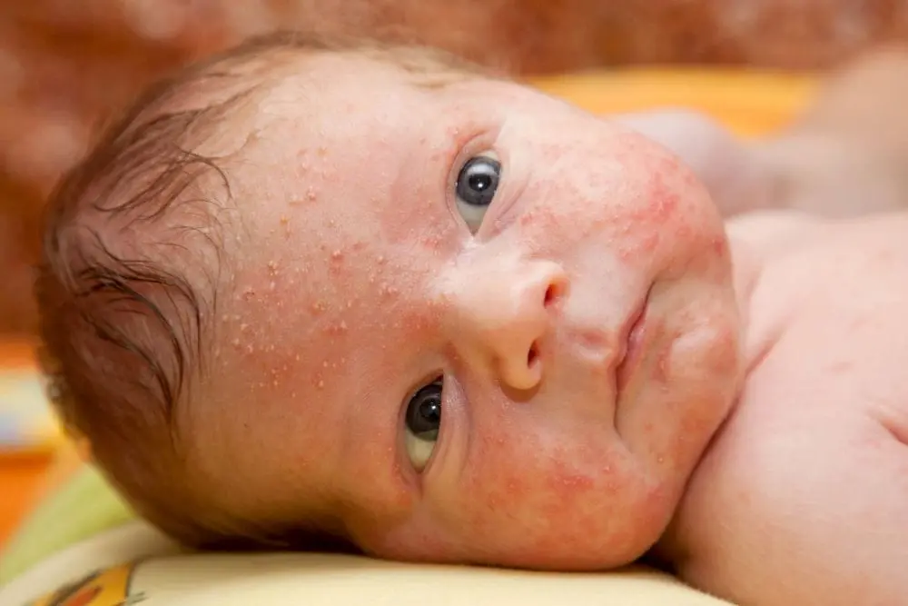 Baby acne &#8211; causes, symptoms, treatment and prevention. Skin care for baby acne