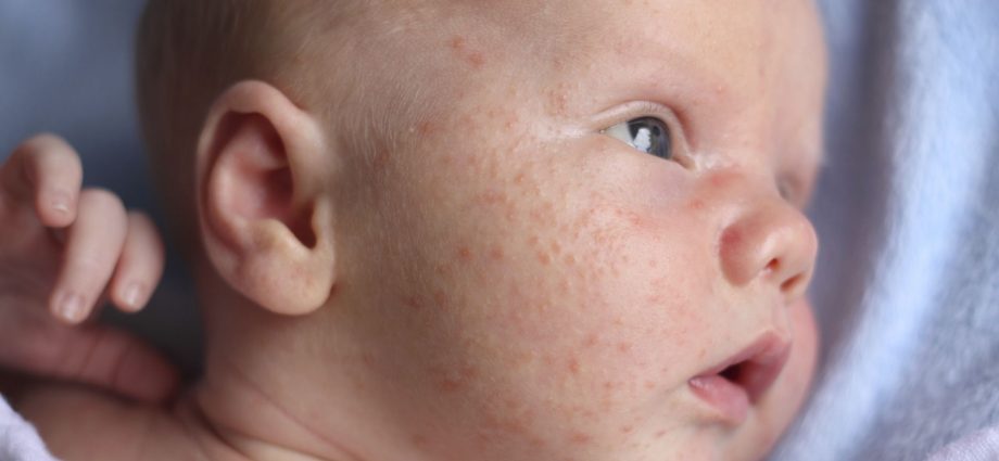 Baby acne &#8211; where does it come from?