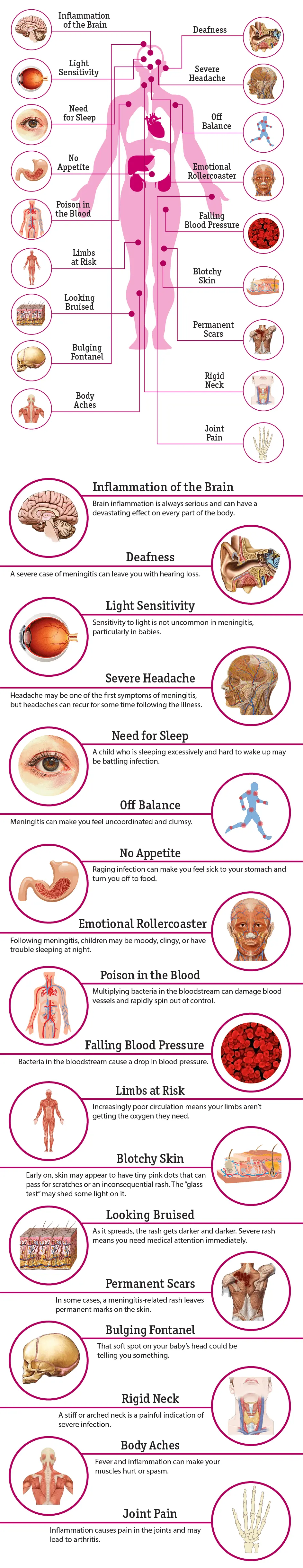 Bacterial meningitis &#8211; causes, symptoms, treatment