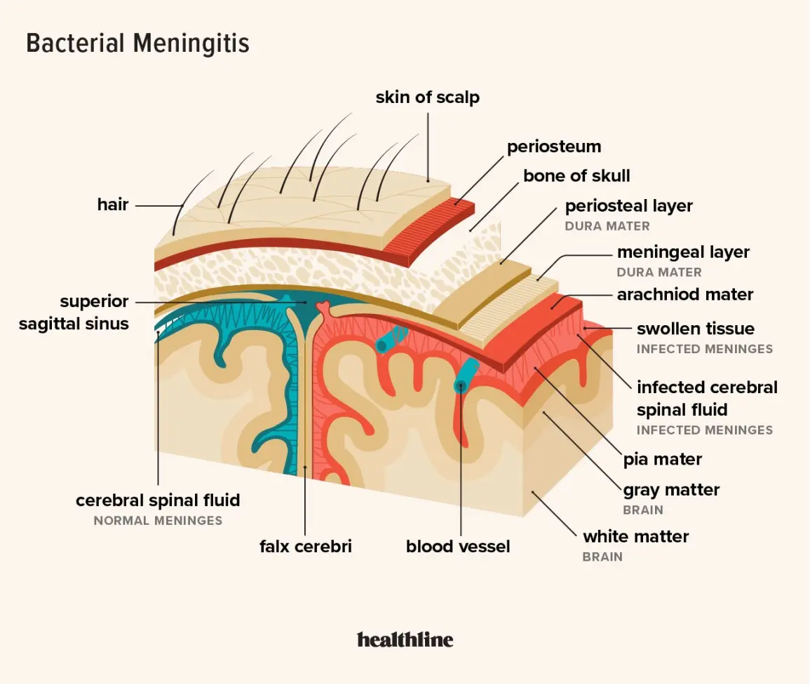 Bacterial meningitis &#8211; symptoms, causes, treatment