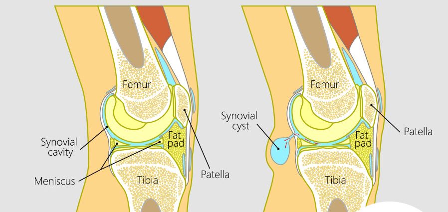 Baker&#8217;s cyst &#8211; causes, symptoms, treatment, rehabilitation