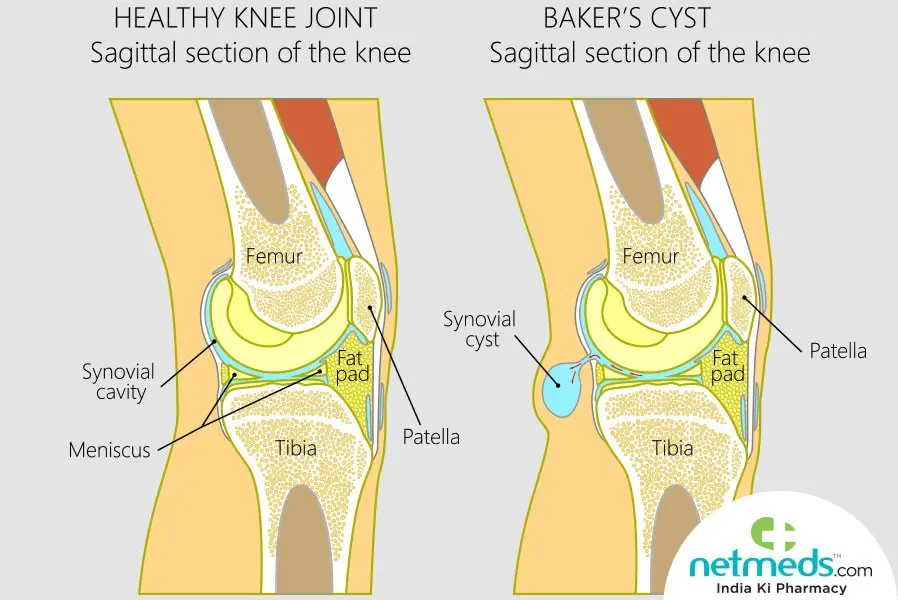 Baker&#8217;s cyst &#8211; causes, symptoms, treatment, rehabilitation