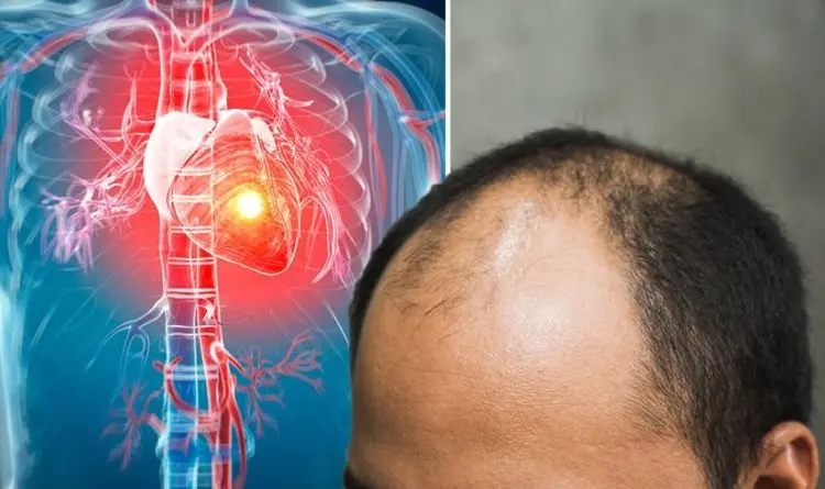 Baldness on top of the head is an unusual symptom of heart disease