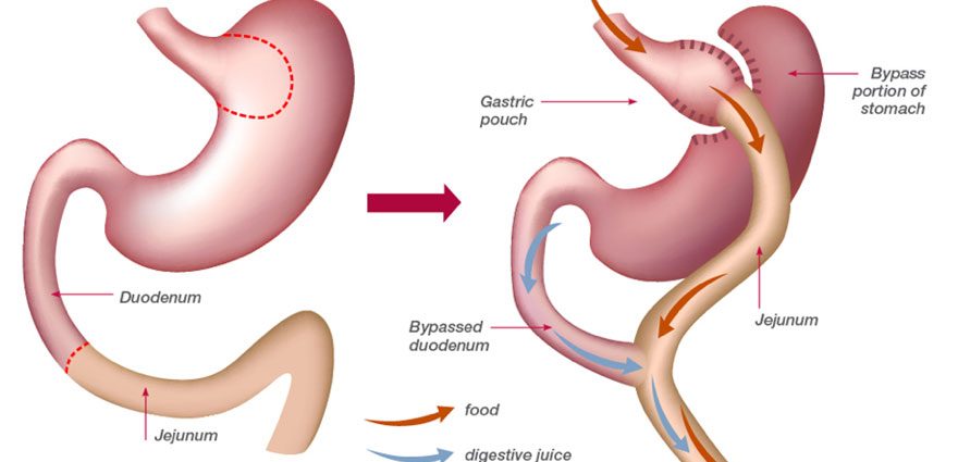 Bariatric surgery