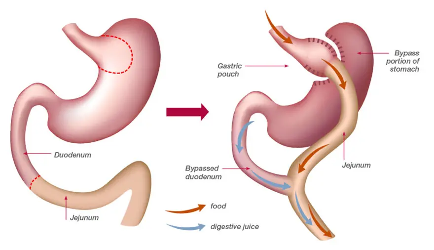 Bariatric surgery