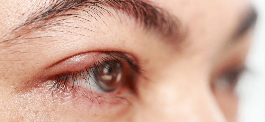 Barley on the eye &#8211; causes, symptoms, treatment, home remedies