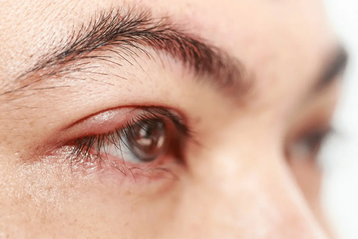 Barley on the eye &#8211; causes, symptoms, treatment, home remedies