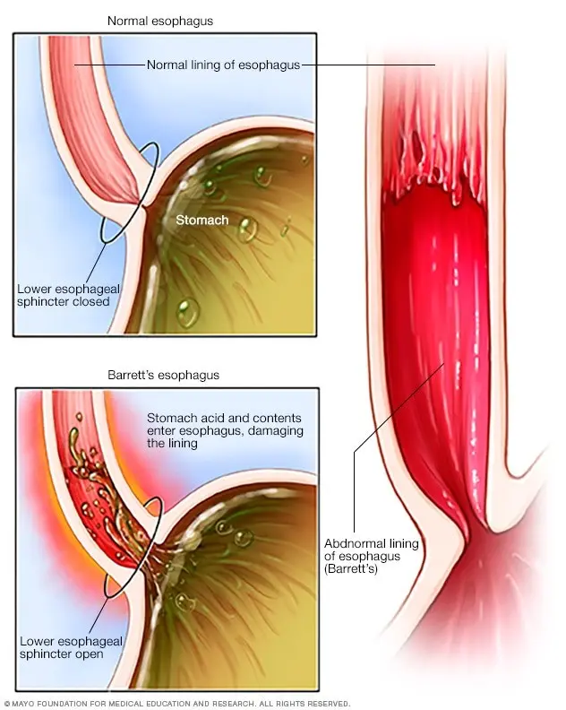 Barrett&#8217;s esophagus &#8211; causes, symptoms, treatment