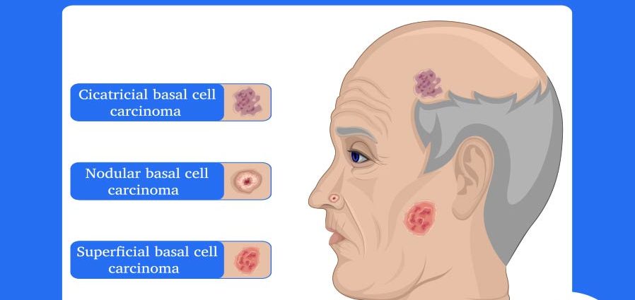 Basal cell carcinoma &#8211; causes, symptoms, diagnosis, treatment, prognosis