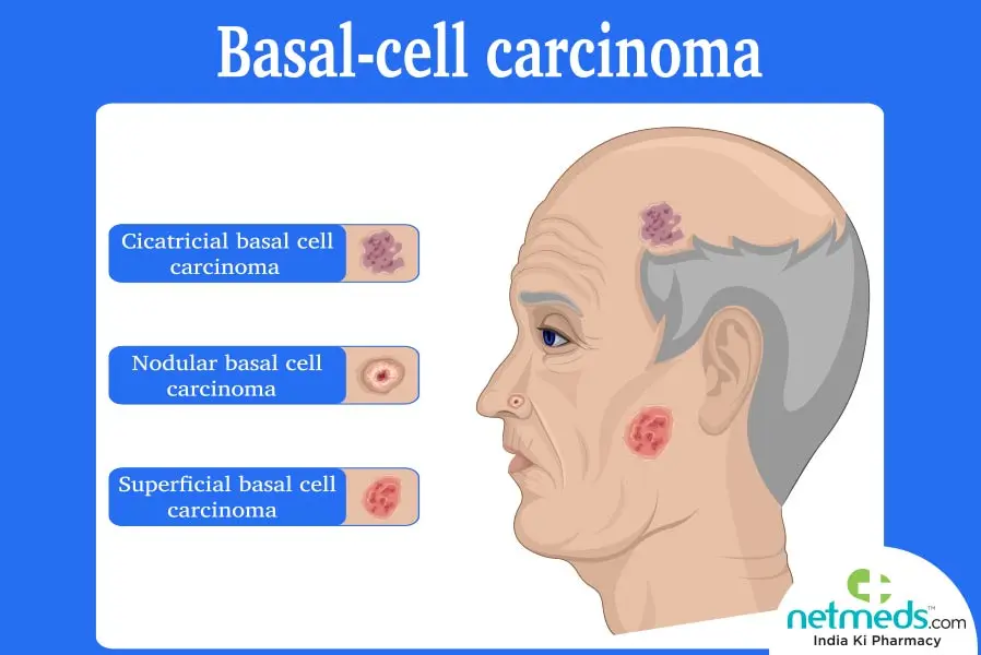 Basal cell carcinoma &#8211; causes, symptoms, diagnosis, treatment, prognosis