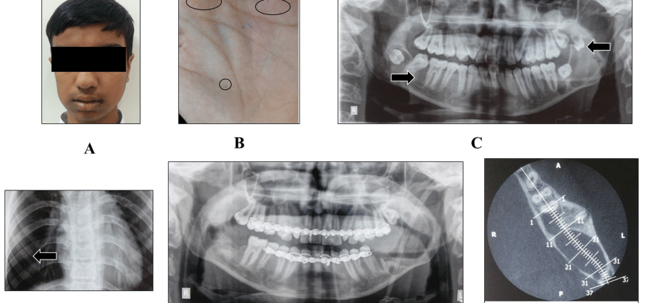 Basal cell epithelioma syndrome