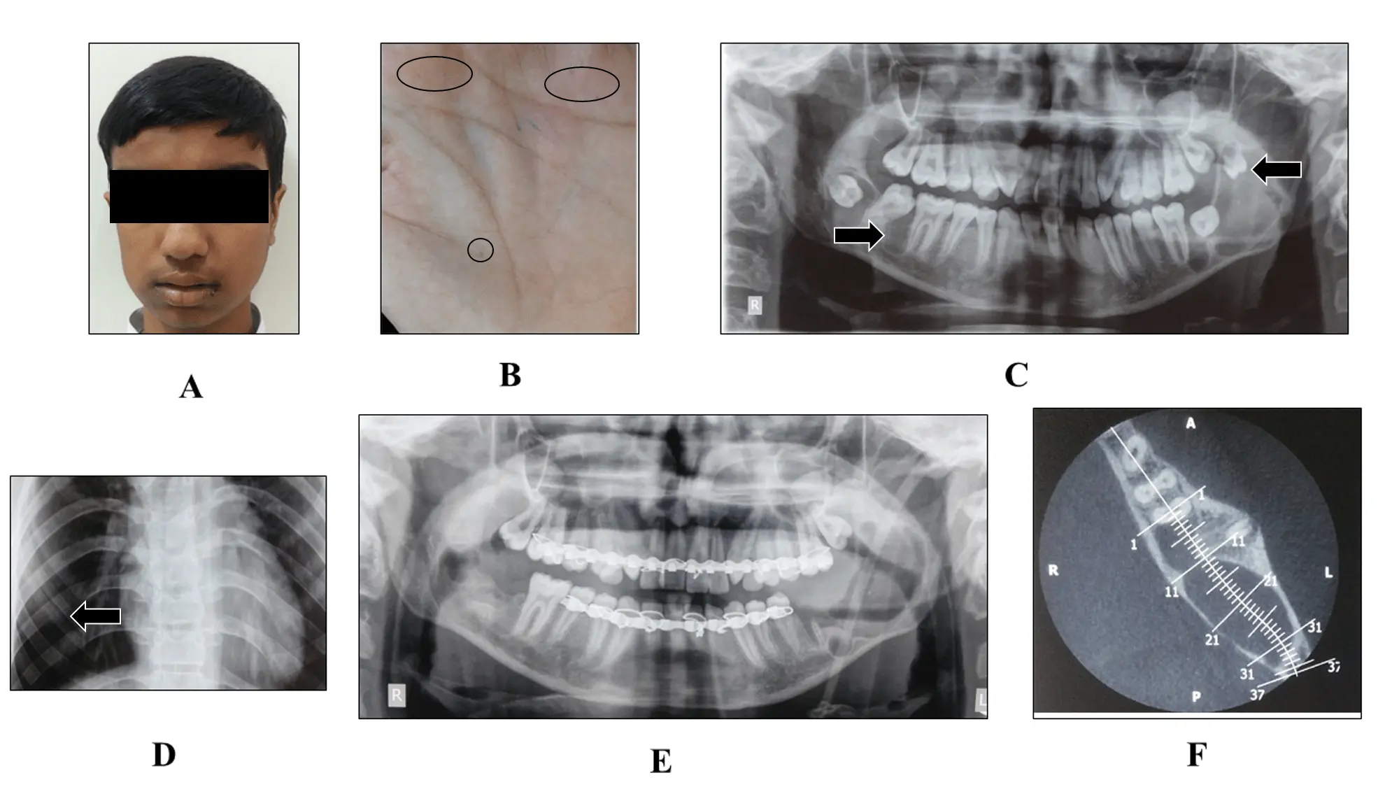 Basal cell epithelioma syndrome